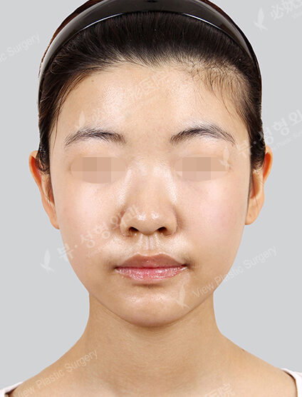 Facial Contouring After