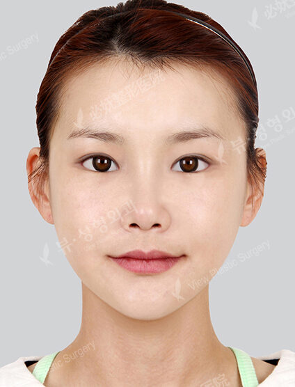Doll Line (Vline)+ Zygoma Reduction+Frontal Cheek Implant+Face Fat Graft+Rhinoplasty+Fat Graft (1 Month) — After