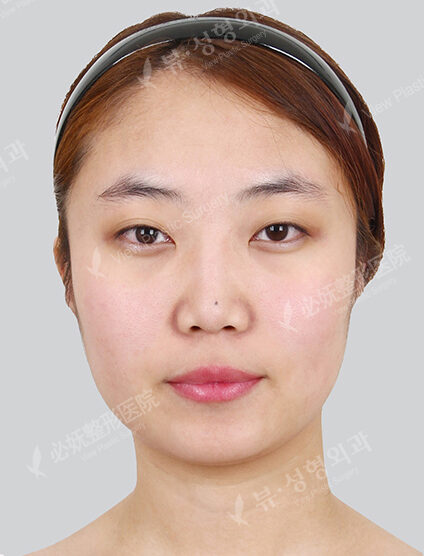 Natural Vline+Zygoma Reduction+PA+Forehead , Frontal Cheeks Fat Graft+Rhinoplasty+Fat Graft (1 Month) — Before
