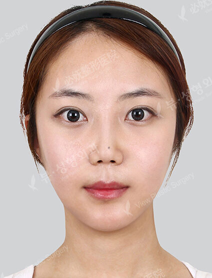 Natural Vline+Zygoma Reduction+PA+Forehead , Frontal Cheeks Fat Graft+Rhinoplasty+Fat Graft (1 Month) — After