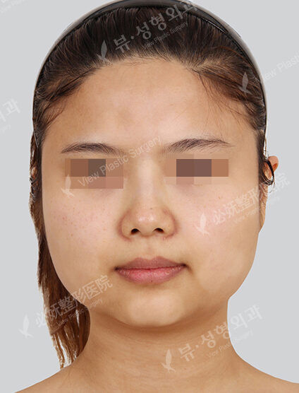 Facial Contouring Before