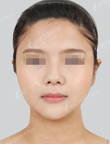 Facial Contouring After