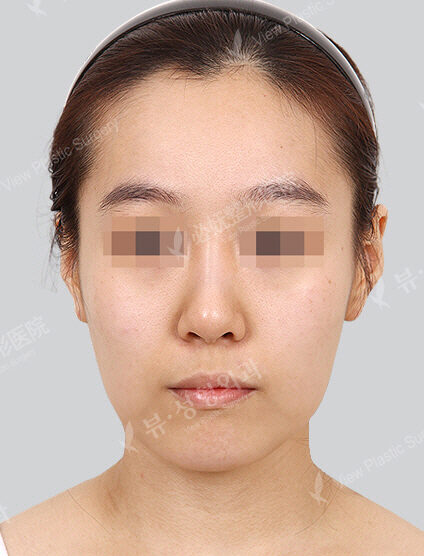 Natural Vline+Zygoma Reduction(1 Month) — Before