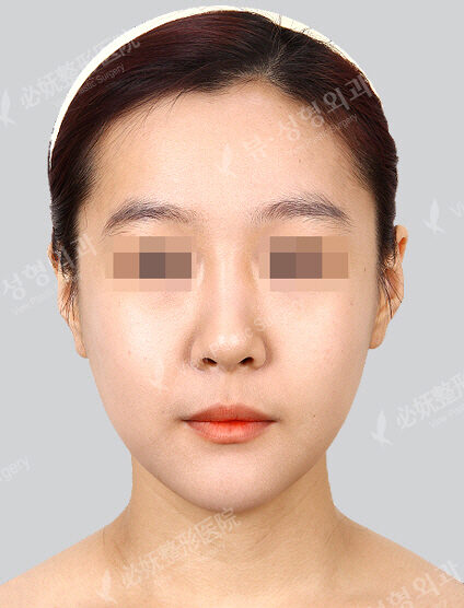 Natural Vline+Zygoma Reduction(1 Month) — After