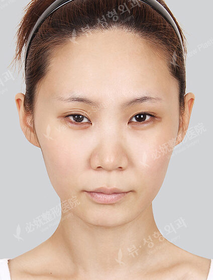 Facial Contouring Before