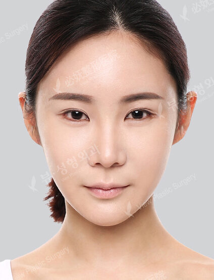 Facial Contouring After