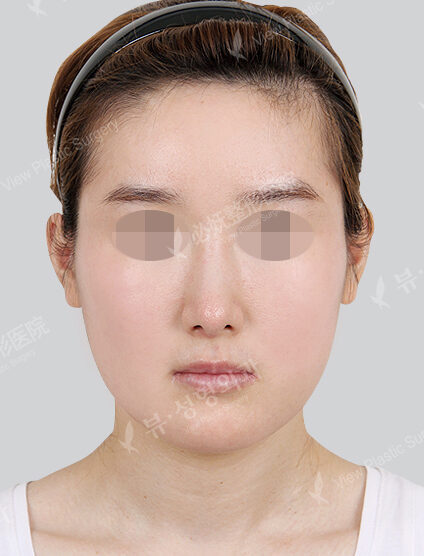 Natural Vline+Zygoma Reduction+Angular Jaw Reduction (1 Month) — Before