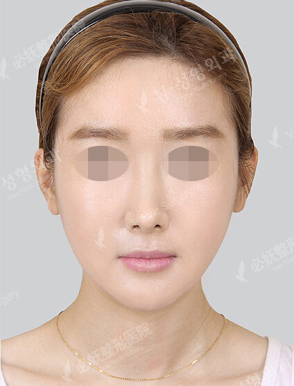 Natural Vline+Zygoma Reduction+Angular Jaw Reduction (1 Month) — After