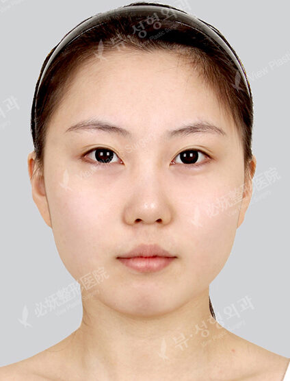 Facial Contouring Before