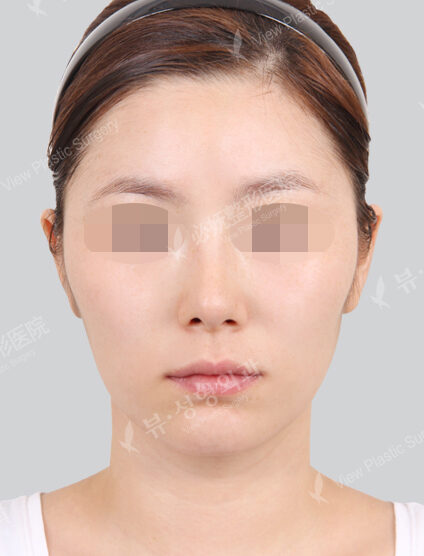 Natural Vline+Zygoma Reduction (1 Month) — Before