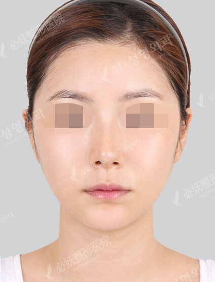 Natural Vline+Zygoma Reduction (1 Month) — After