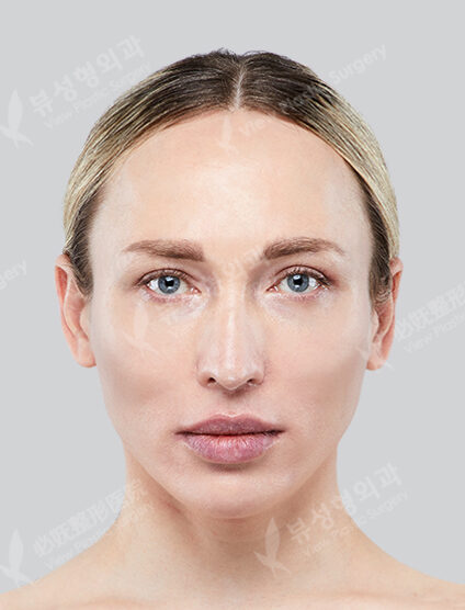 Zygoma Reduction+Angular Jaw Reduction+Genioplasty+PA (6 Months) — Before