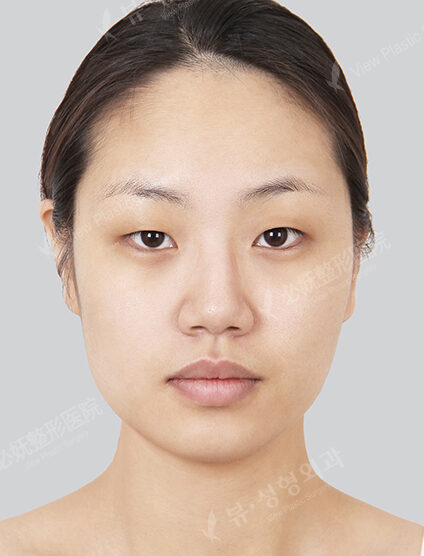 Facial Contouring Before