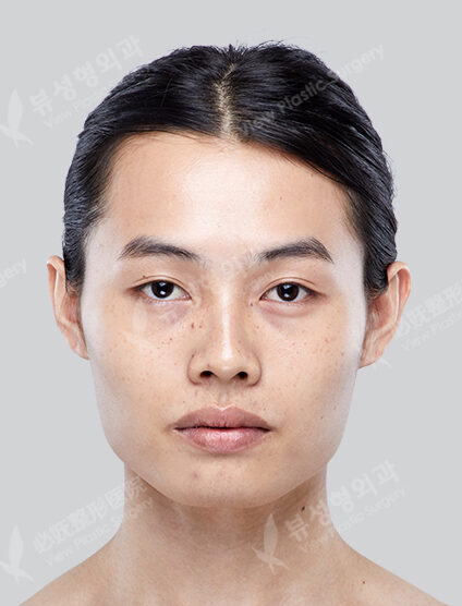 Zygoma Reduction+Angular Jaw Reduction+Genioplasty+Fat Graft (6 Months) — Before