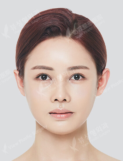 Zygoma Reduction+Angular Jaw Reduction+Genioplasty+Fat Graft (6 Months) — After