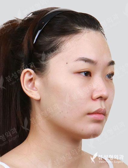 Facial Contouring Before