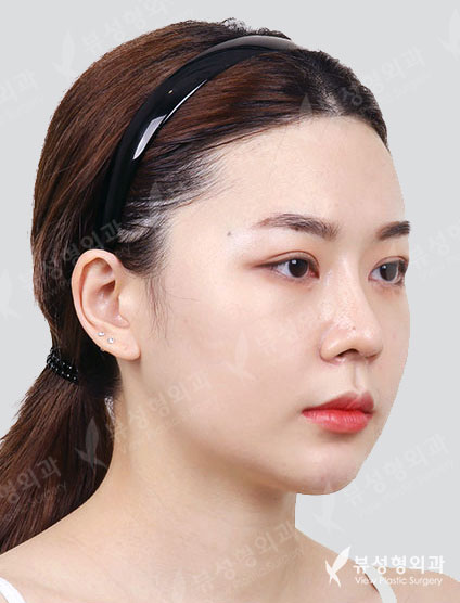 Facial Contouring After