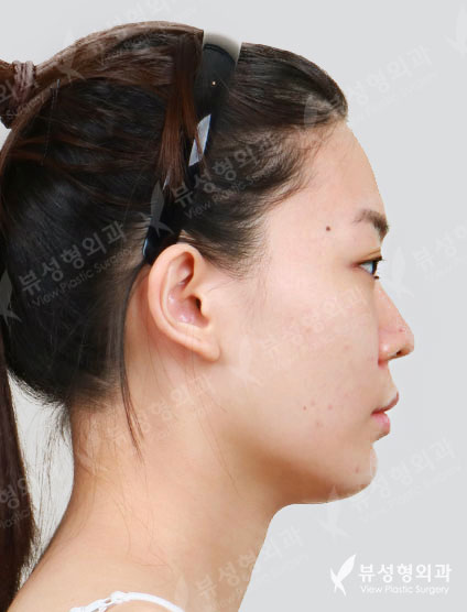 Facial Contouring Before