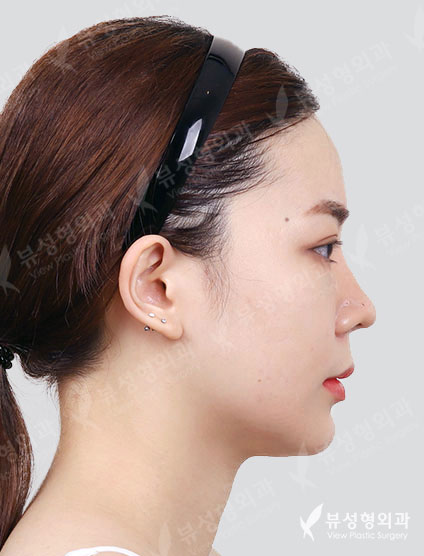 Facial Contouring After