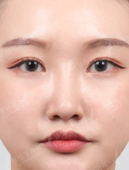 Revisional Rhinoplasty — After
