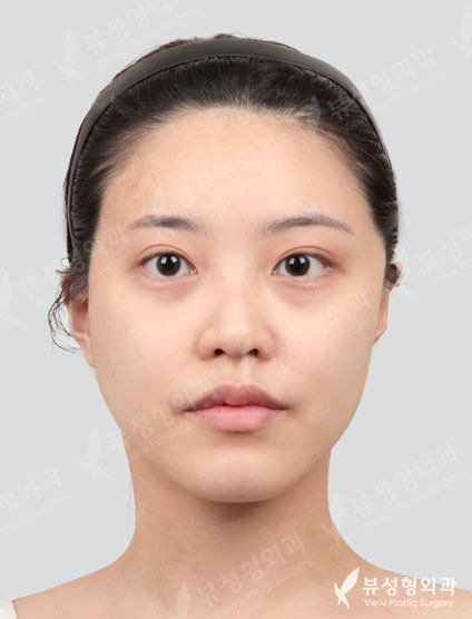 Facial Contouring Before