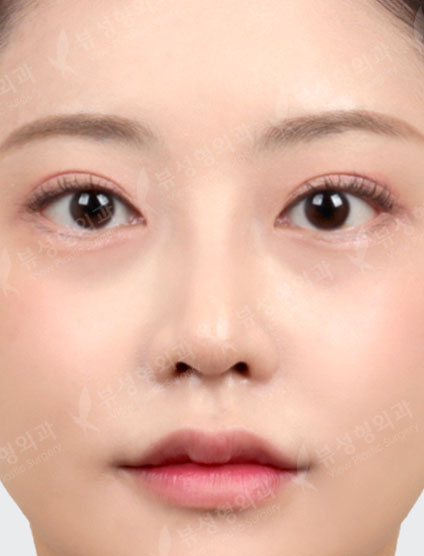 Rhinoplasty + 3 Types Face Contouring — After