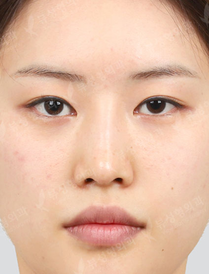 Nose Before