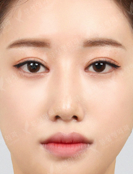 Nose After