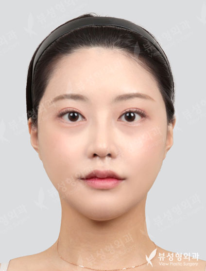 3 Types Face Countouring+Rhinoplasty — After