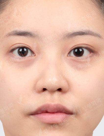 Rhinoplasty +3 Types Face Countouring — Before