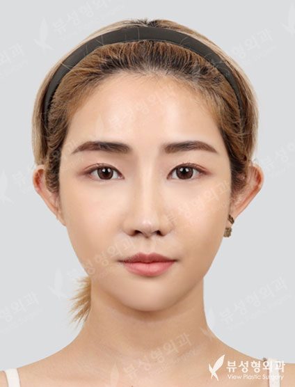 korean plastic surgery before and after jaw