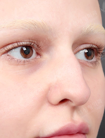 Nose Before