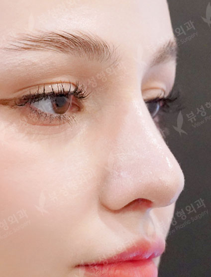 Nose After