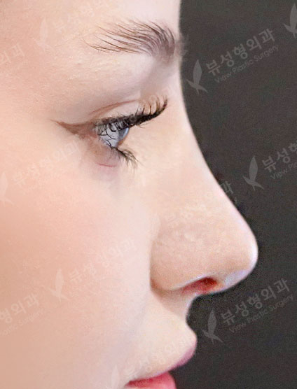 Nose After