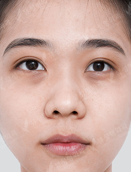 Under Eye Fat Reposition + Rhinoplasty — Before