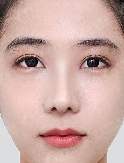 Under Eye Fat Reposition + Rhinoplasty — After
