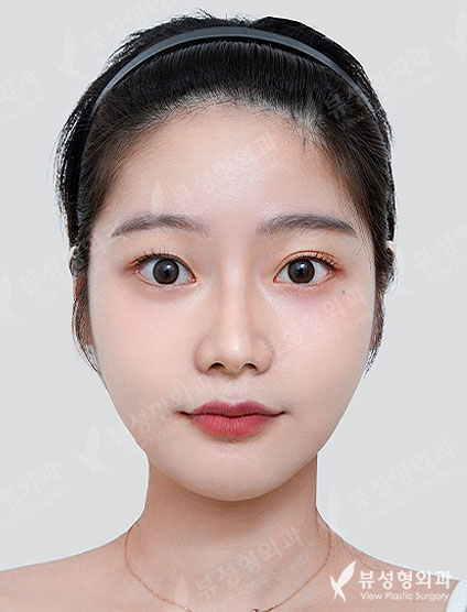 Facial Contouring + Rhinoplasty — After