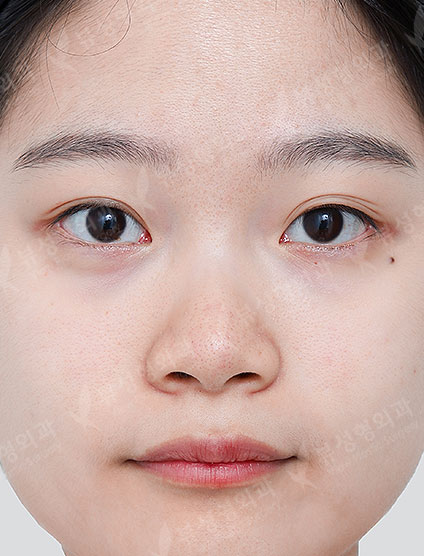 Rhinoplasty + Facial Contouring — Before