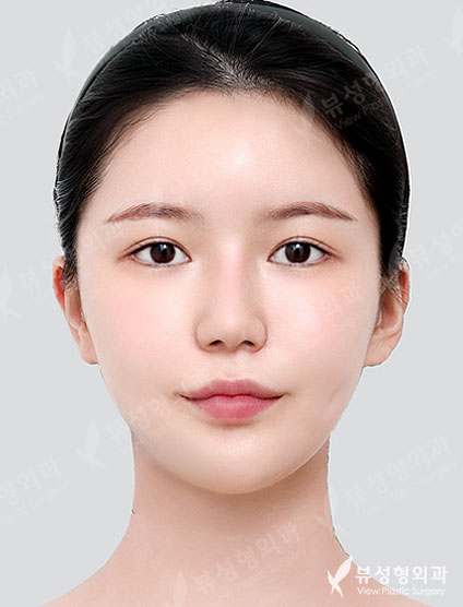 Rhinoplasty + Double Eyelid Surgery + Canthoplasty + Thread lift + Fat Graft — After