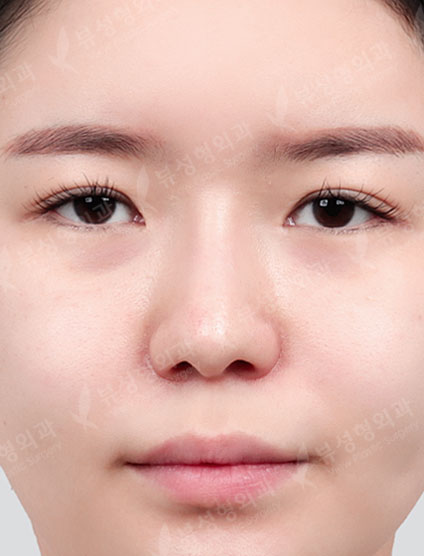 Rhinoplasty + Double Eyelid Surgery + Canthoplasty + Thread lift + Fat Graft — Before