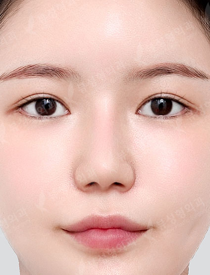 Rhinoplasty + Double Eyelid Surgery + Canthoplasty + Thread lift + Fat Graft — After