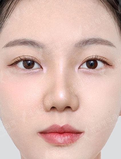 Rhinoplasty (4Months) — After