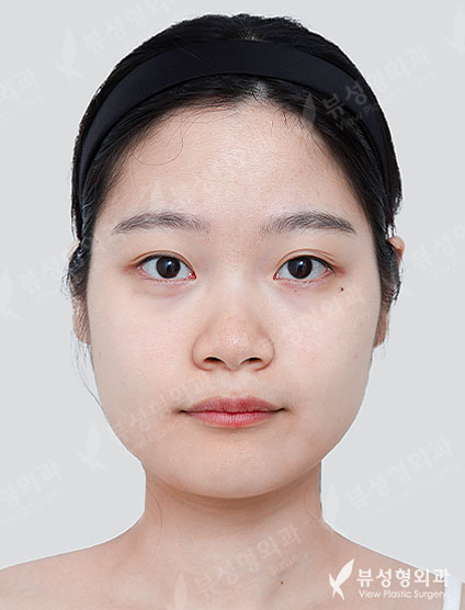 3 Types Facial Contouring + Rhinoplasty — Before