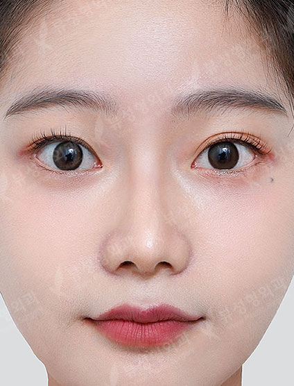 3 Types Facial Contouring + Rhinoplasty — After