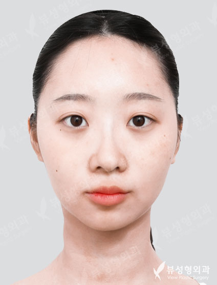 3 Types Facial Contouring + Rhinoplasty — Before