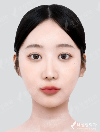 3 Types Facial Contouring + Rhinoplasty — After