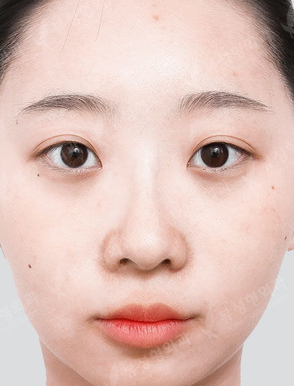 3 types Facial Contouring + Rhinoplasty — Before