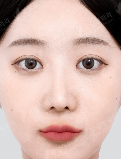 3 types Facial Contouring + Rhinoplasty — After