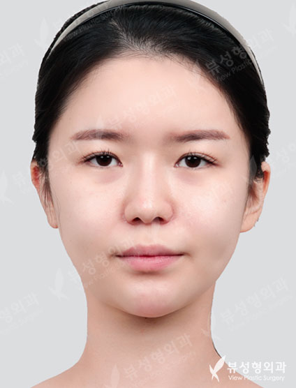 Double Eyelid Revision Surgery + Revision Rhinoplasty + Thread Lift + Fat Graft — Before