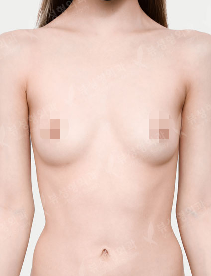 Breast Augmentation (Sebbin) (2 Months) — Before
